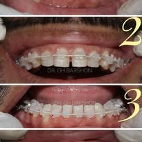 Orthodontics & Braces Treatment